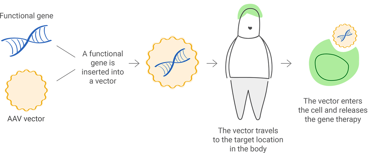 3 steps of adeno-associated virus (AAV) therapy shown in illustration. 1) Functional gene is inserted into vector. 2) Vector travels to target location in the body. 3) Vector enters target cell and releases gene therapy.